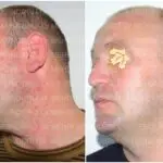 Üzdə qızartı