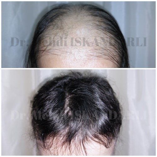 Saç tökülməsi zamanı dermatoloqa müraciət