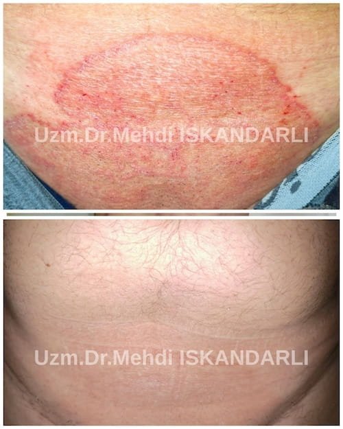 cinsi yolla keçən xəstəliklərin əlamətləri