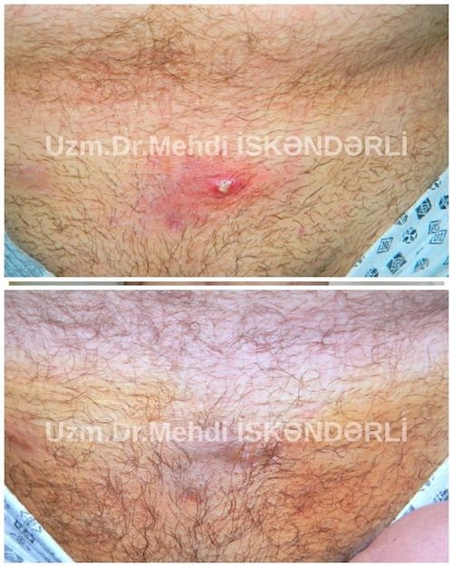cinsi yolla keçən xəstəliklərin əlamətləri
