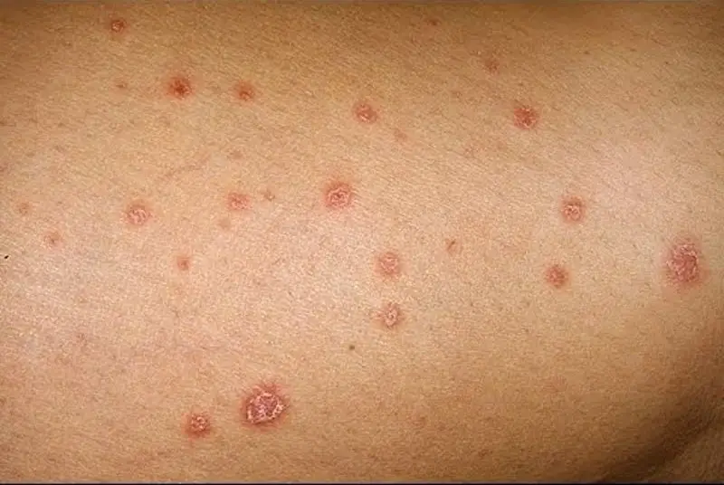 uşaqlarda damcıvari psoriaz