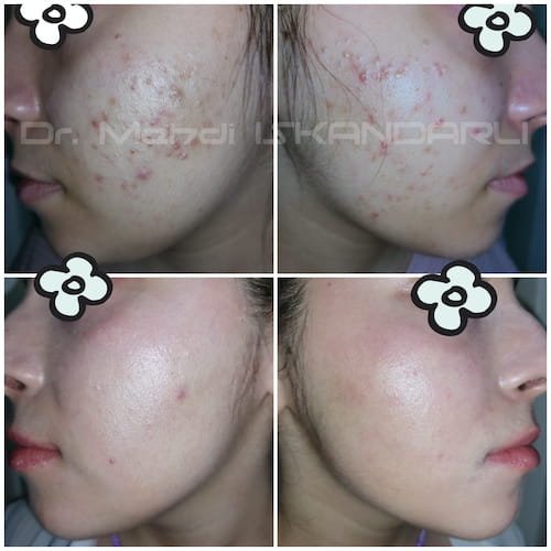 sızanaq ləkələri üçün krem