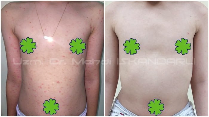 usaqlarda damcivari psoriaz
