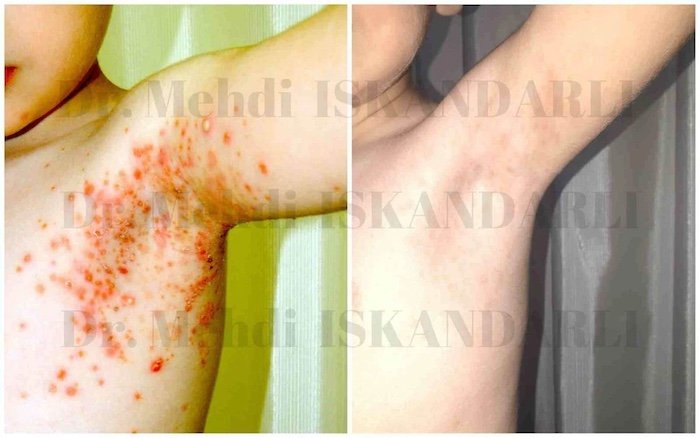 uşaqlarda damcıvari psoriaz