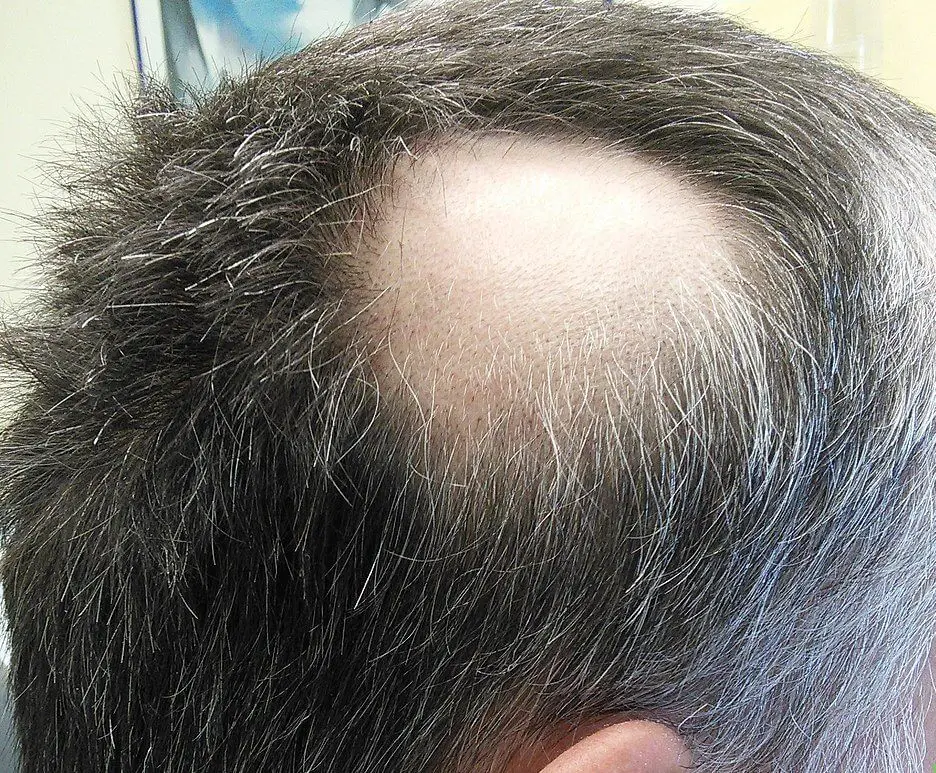 Ocaqlı alopesiya