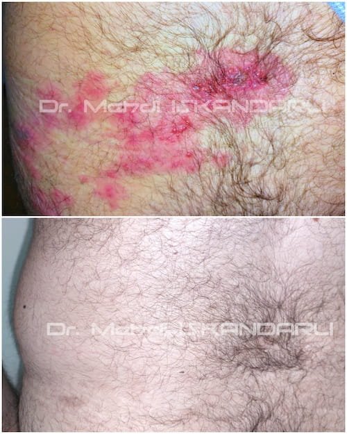 kəmərləyici dəmrov xəstəliyi