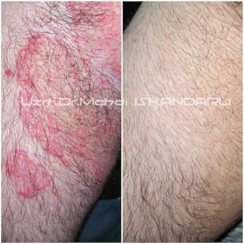 qasıqda göbələk xəstəliyi