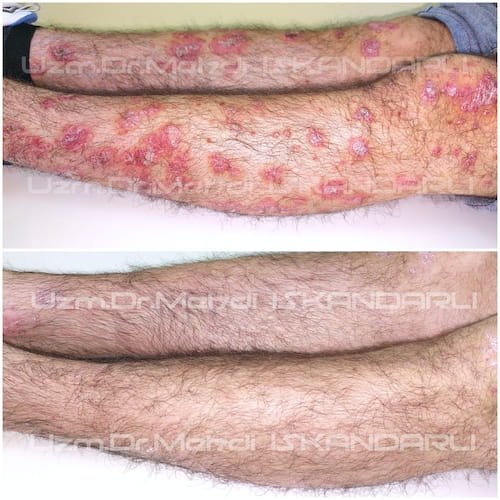 pullu dəmrov xəstəliyi