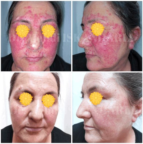 gənə xəstəliyinin müalicəsi