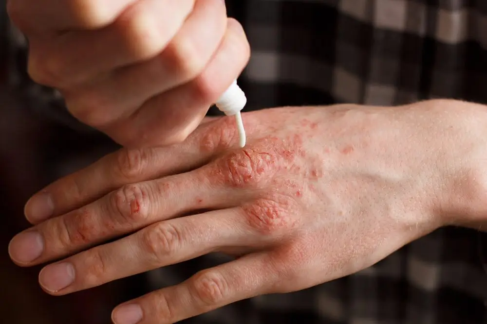 Psoriazın müalicəsi varmı