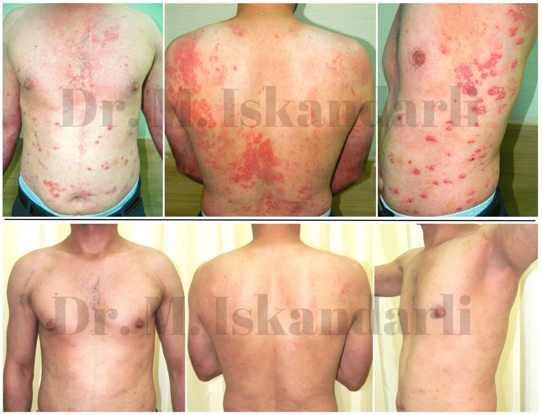 psoriaz xəstəliyi