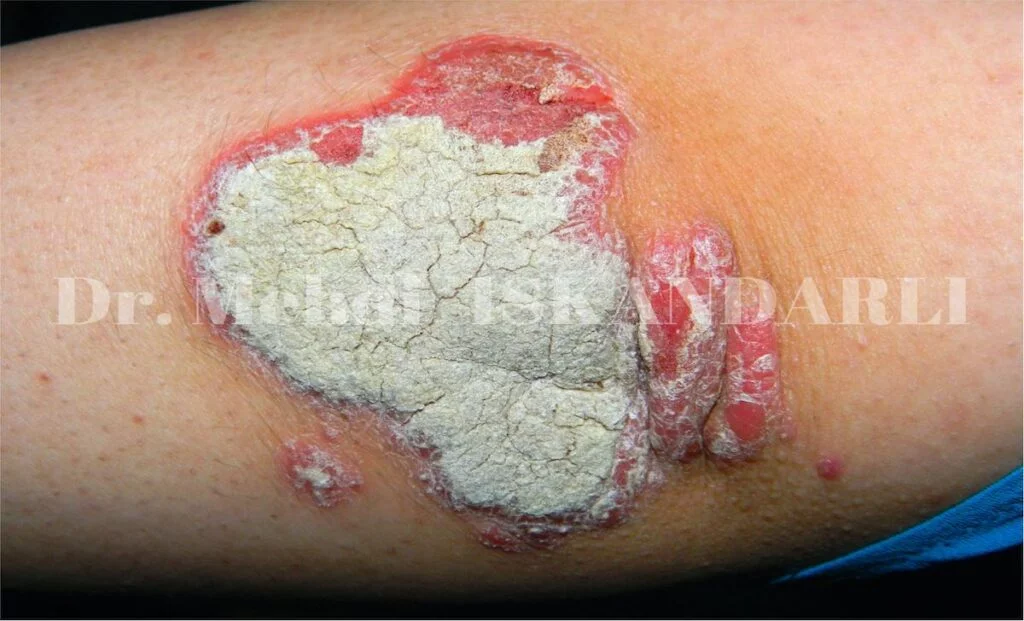 dirsəkdə qabıqlanma