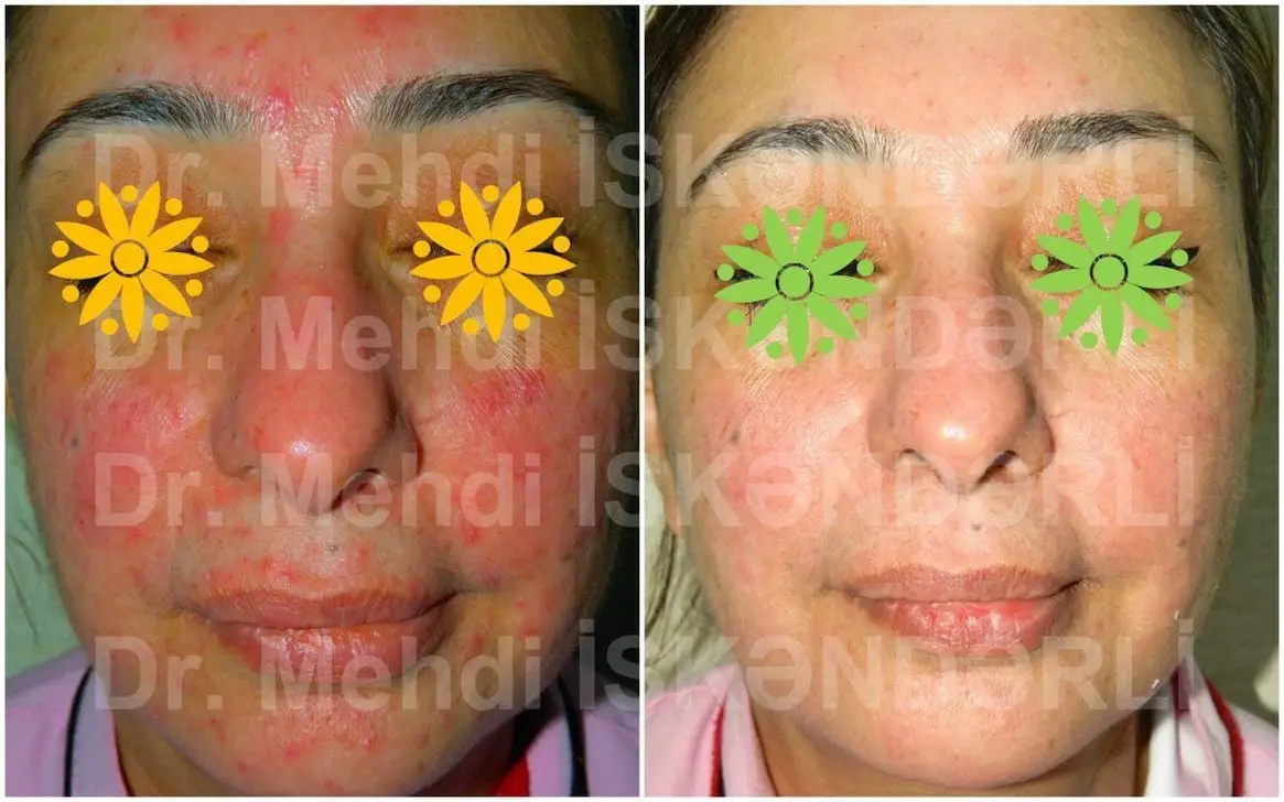 Lupus xəstəliyi təhlükəlidirmi