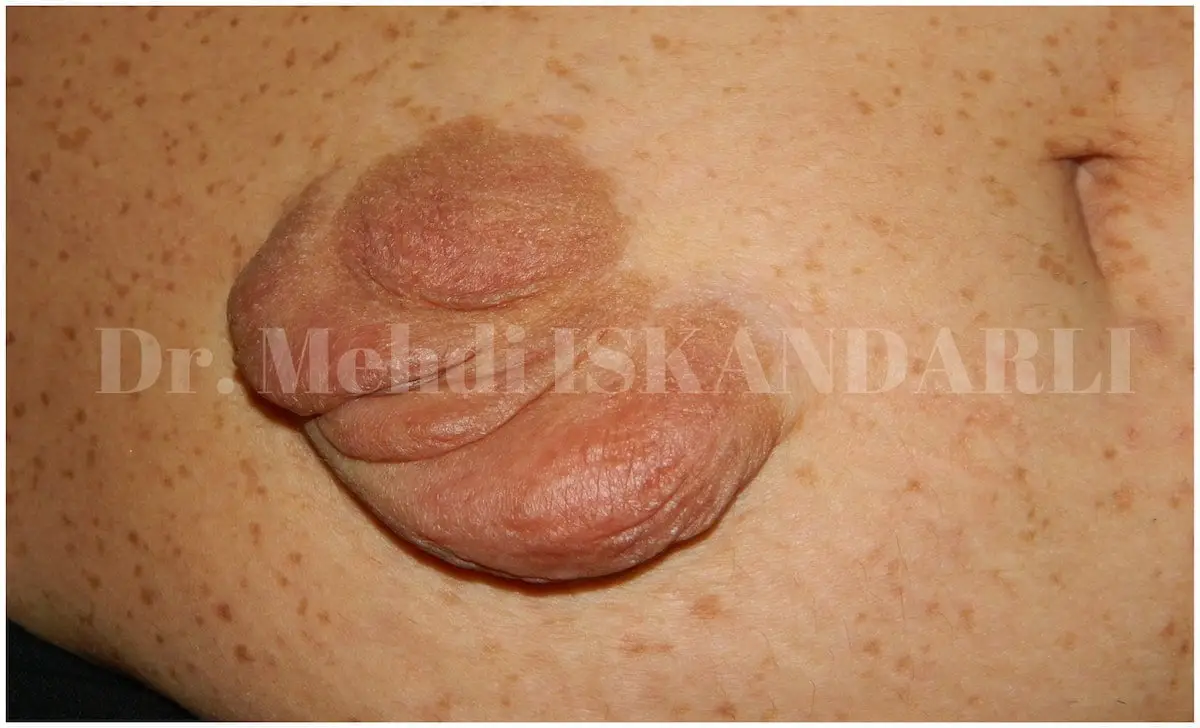 neyrofibromatoz xəstəliyinin müalicəsi