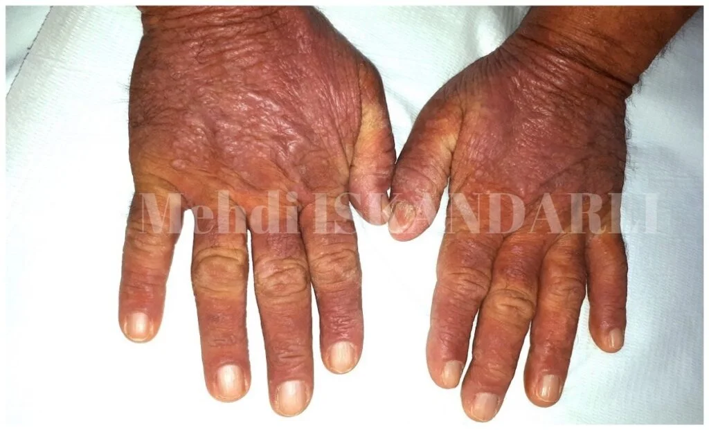 əllərdə qaşıntı