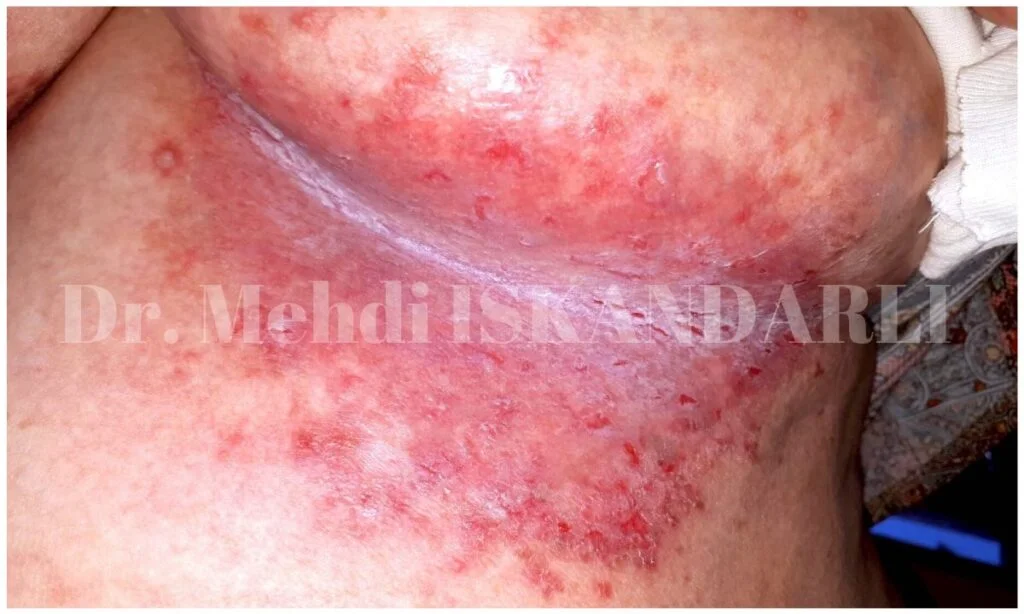 məmə altında qaşınma