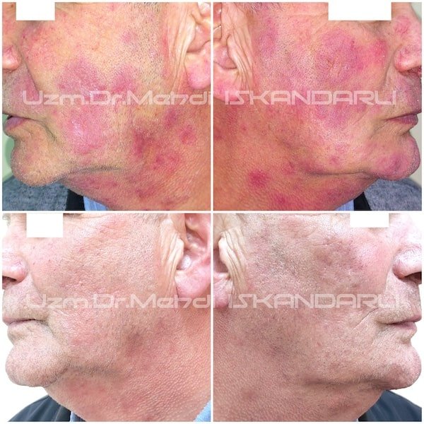 qırmızı qurd eşənəyi