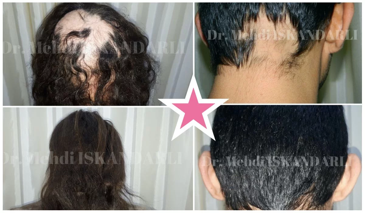 saçlarda tala tala tökülmə