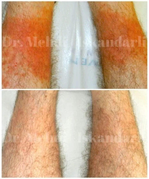 topuqlarda qırmızı səpgilər