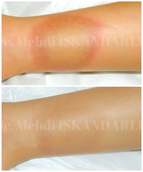 topuqda qırmızı səpgilər