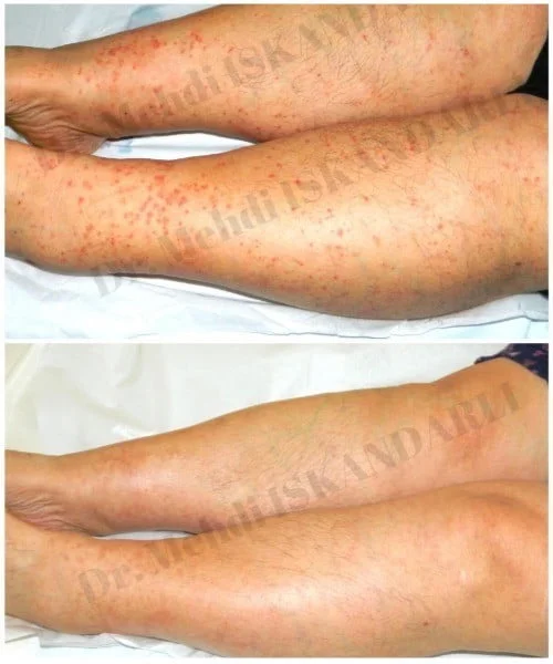 baldırlarda qırmızı səpgilər