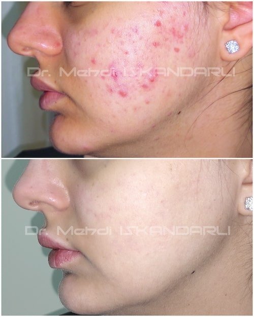 roaccutane dərmanı