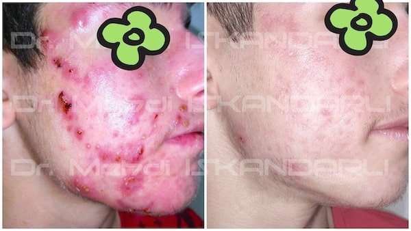 roaccutane dərmanı