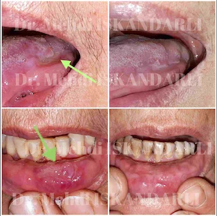 oral aftoz stomatit