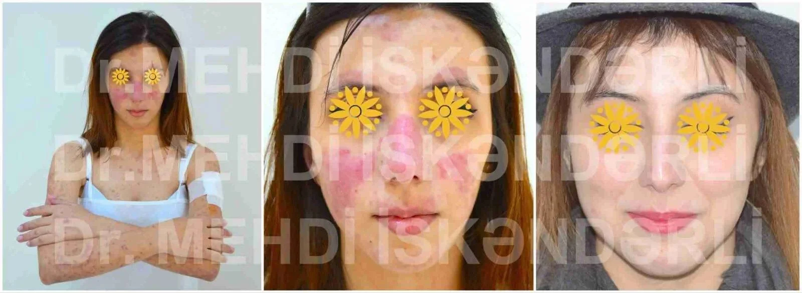qırmızı qurd eşənəyi xəstəliyi