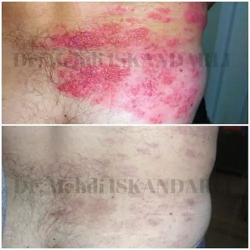 beldə herpes