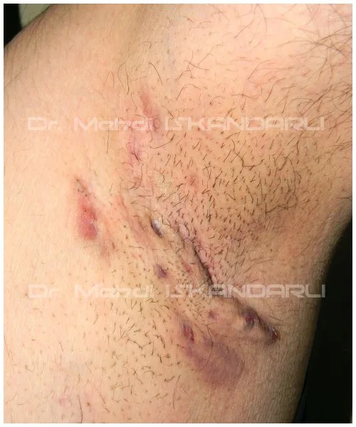 qoltuqaltında ağrılı şişkinlik