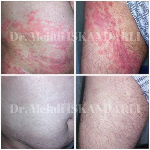 dəri xəstəlikləri