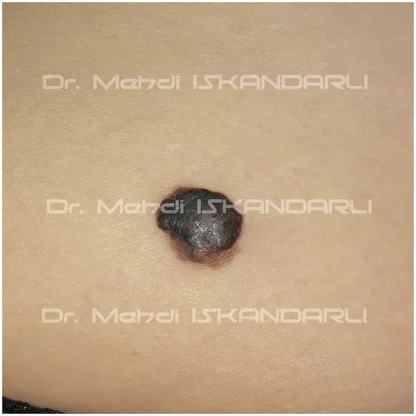 melanoma