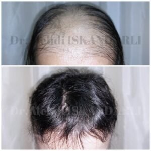ocaqlı alopesiya