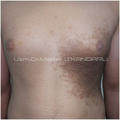 dəridə qəhvəyi ləkələr