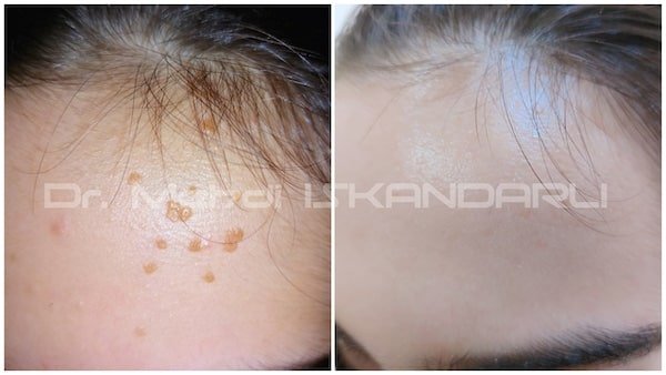 uşaqda üzdə qəhvəyi ləkələr