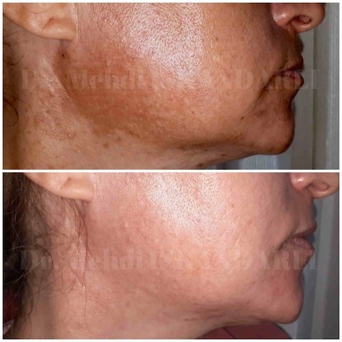 üzdə melazma ləkələri