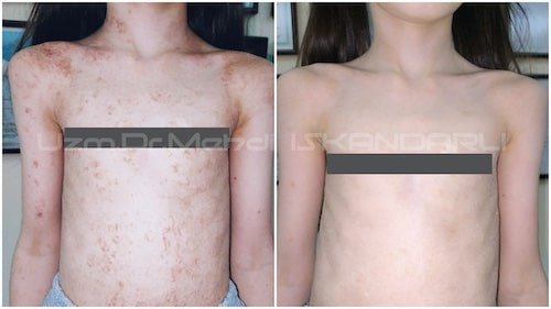 uşaqda bədəndə qaşıntılı qəhvəyi ləkələr