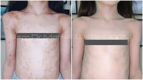 uşaqda bədəndə qaşıntılı qəhvəyi ləkələr
