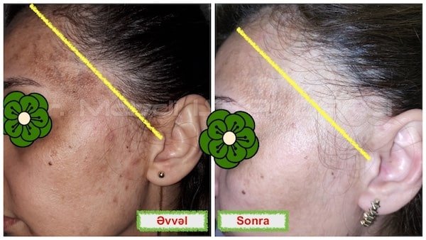 üzdəki melazma ləkələrin müalicəsi