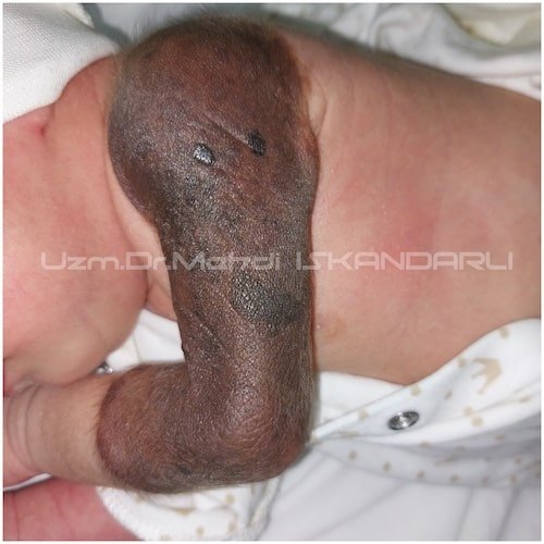 Körpədə bədəndə qəhvəyi ləkə