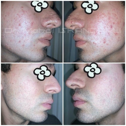 dəri altı səpgilər