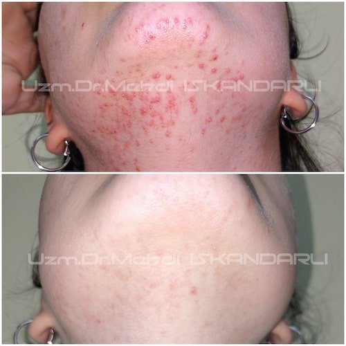 çənəaltı sızanaqlar