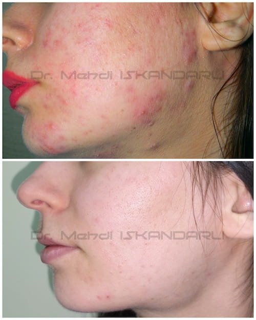 üzdə akne xəstəliyi