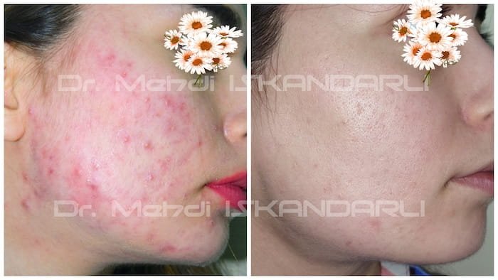 qadınlarda hormonal sızanaqlar