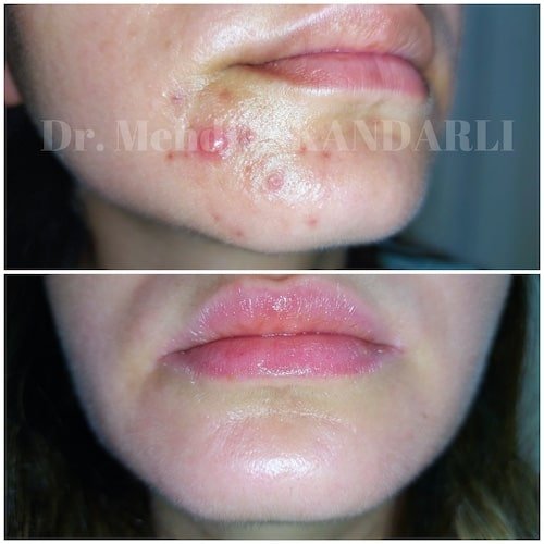 sızanaq xəstəliyi yaranma səbəbi