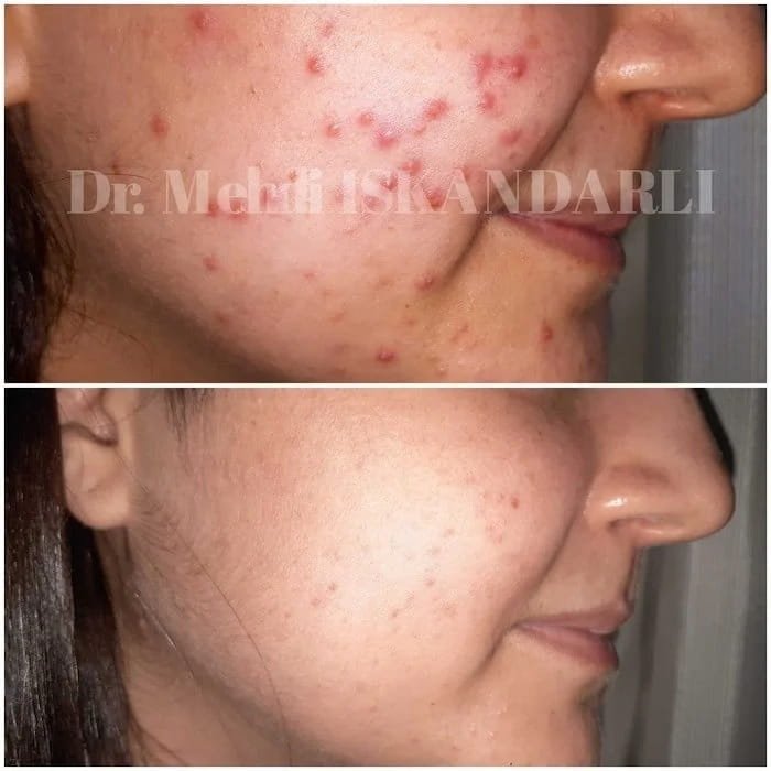 akne yaranma mexanizmi
