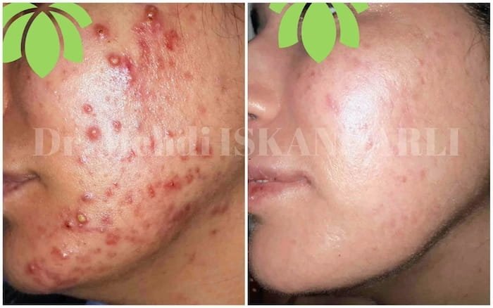 sızanaq necə yaranır