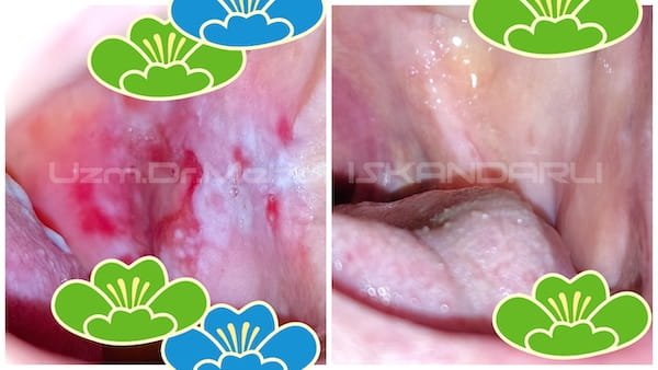 ağızda yaralar