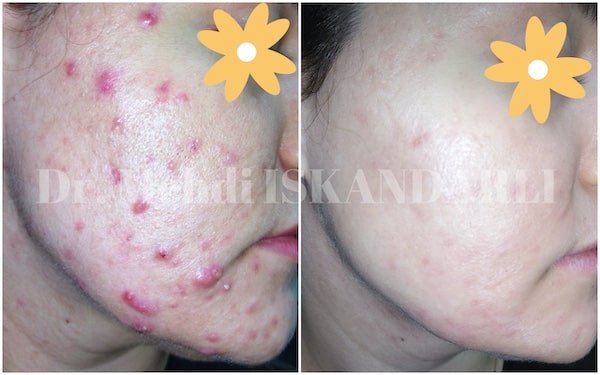 üzdəki sızanaqlar üçün dərman